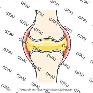 Joint effusion