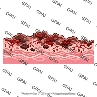 Endometrium necrotic