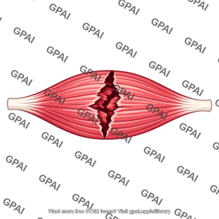 Muscle torn
