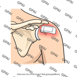 Shoulder postsurgery