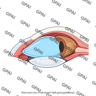 Eye anterior chamber