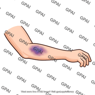 Bruised arm