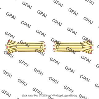 Nerve fiber bundle severed